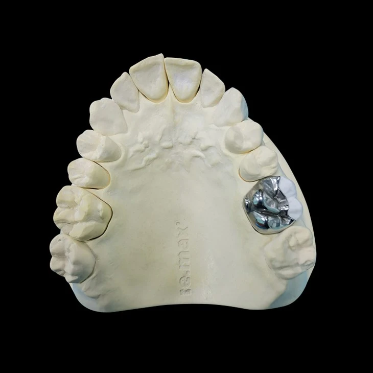 Metal Inlay Or Onlay
